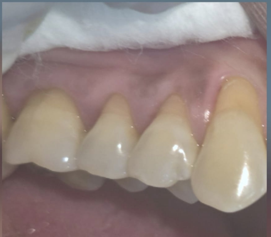 Before photo of cervical abrasion GIC restoration case — Smile Story Dental Clinic, Madurai