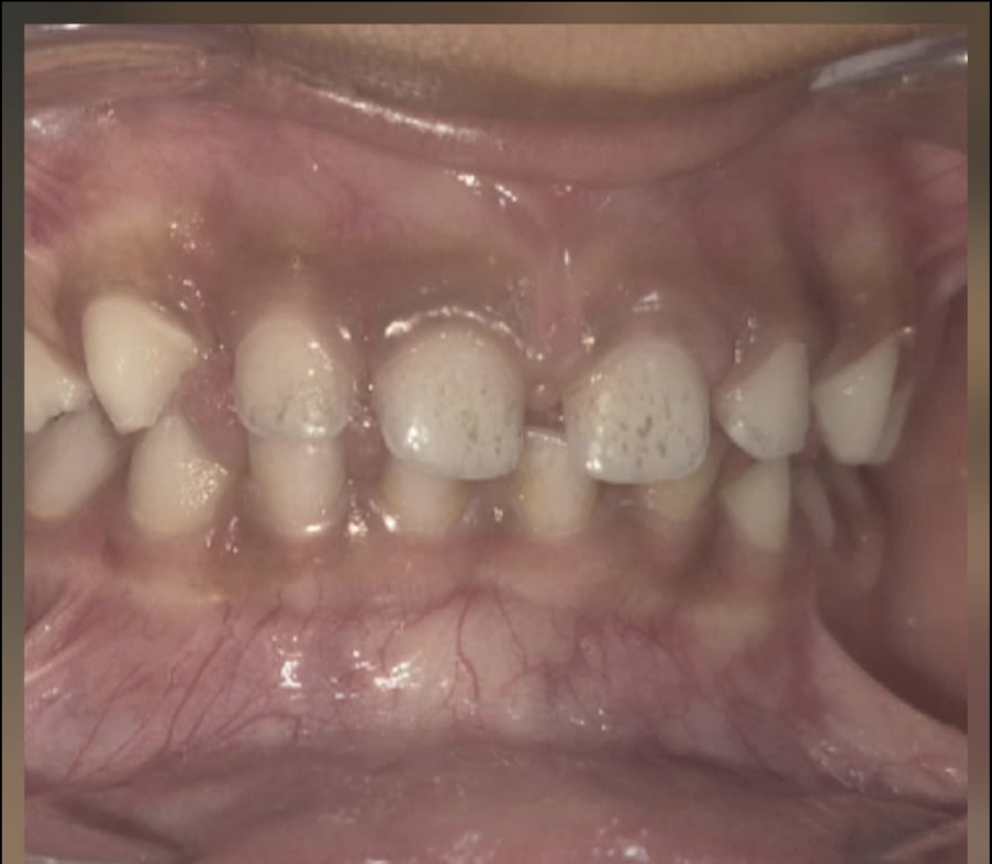 Before photo of professional dental cleaning and polishing — Smile Story Dental Clinic, Madurai