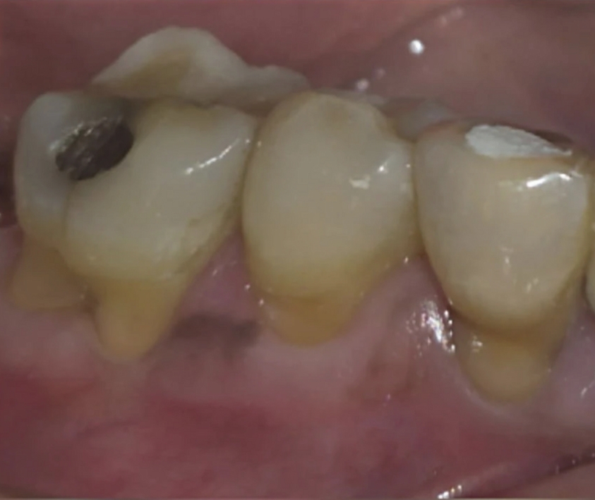 Before photo of tooth-coloured composite filling for decayed molar — Smile Story Dental Clinic, Madurai