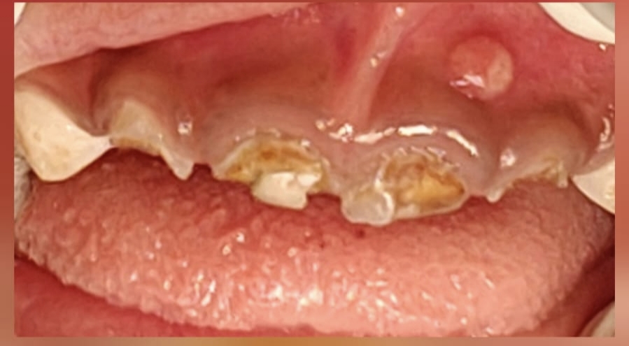 Before photo of full mouth rehabilitation under general anesthesia for early childhood caries — Smile Story Dental Clinic, Madurai