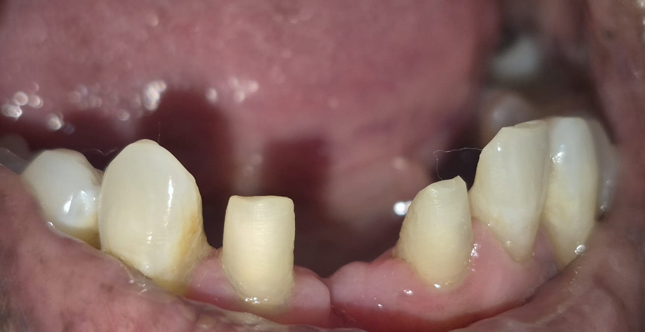 Before photo of fixed dental bridge for missing lower front teeth — Smile Story Dental Clinic, Madurai