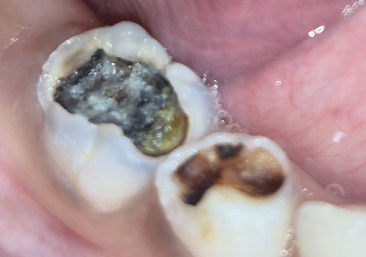 Before photo of metal crown restoration for decayed molar — Smile Story Dental Clinic, Madurai